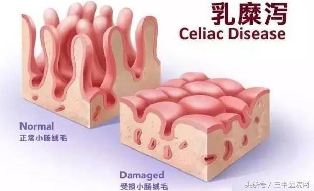 麸质过敏知多少？乳糜泻：进食一定量小麦就可能发病