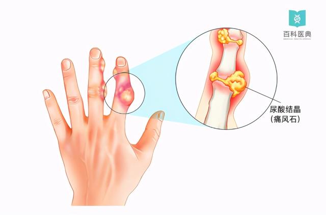 20多岁的男生年纪轻轻就患上了痛风，竟然是因为运动锻炼